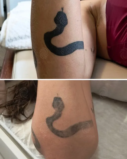 Tatuagem de serpente no braço, antes e durante o tratamento a laser, com o desenho mais claro
